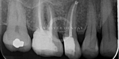 Endodontic after