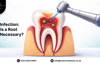 Tooth Infection: When Is a Root Canal Necessary?